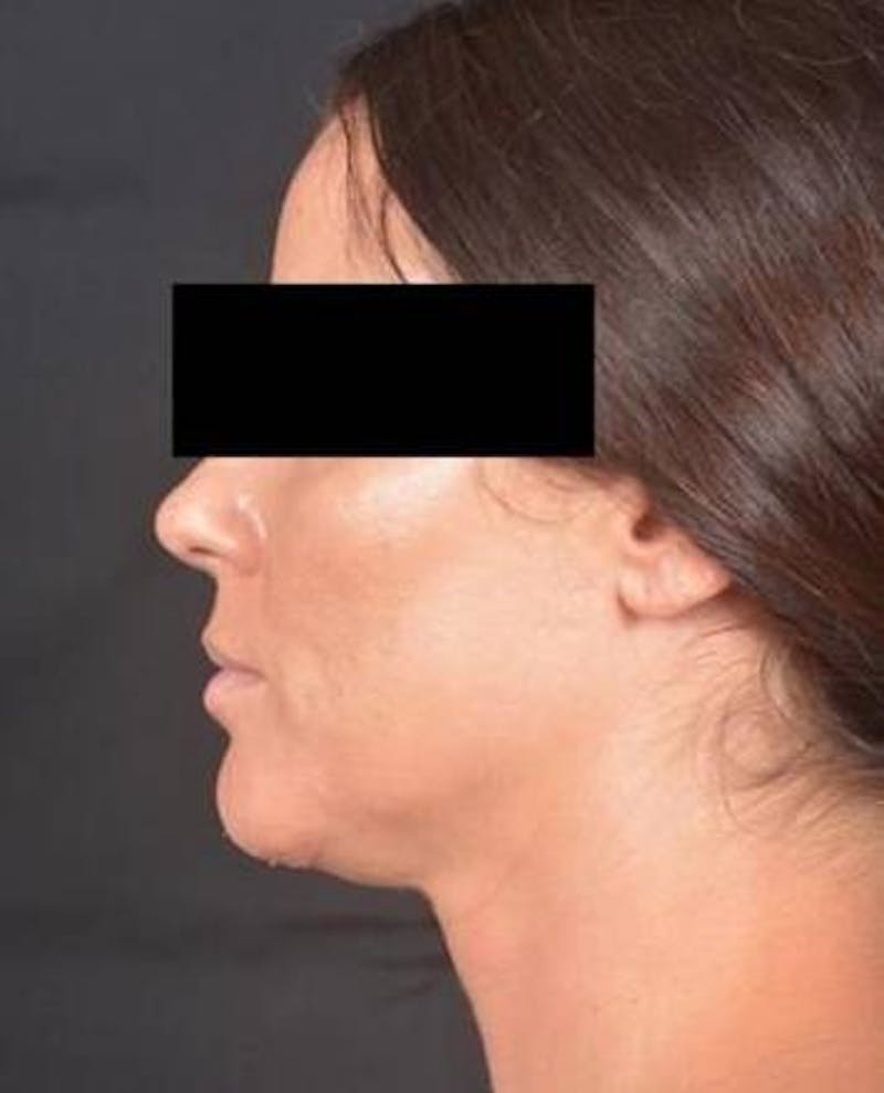 Neck Liposuction Before & After Gallery - Patient 217109 - Image 3
