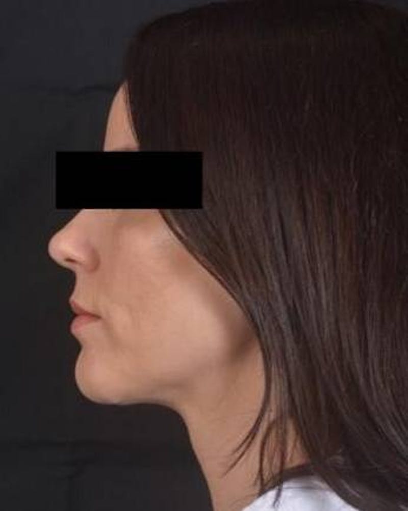 Neck Liposuction Before & After Gallery - Patient 217109 - Image 4