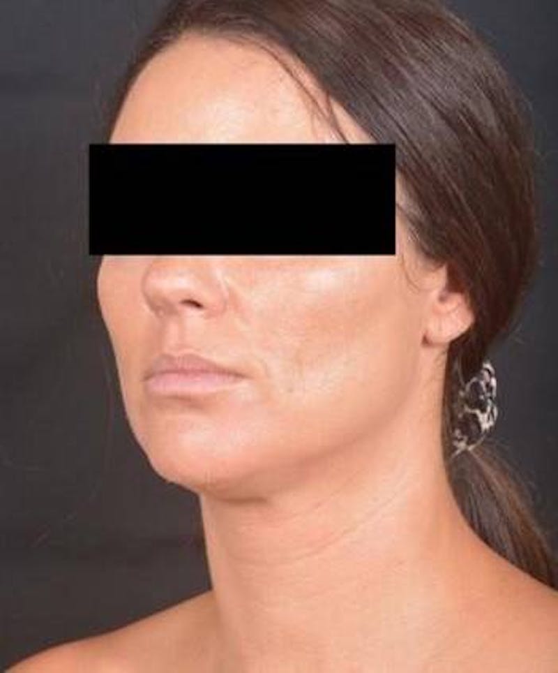 Neck Liposuction Before & After Gallery - Patient 217109 - Image 7