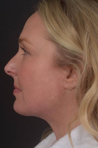 Facelift Before & After Gallery - Patient 212742 - Image 4