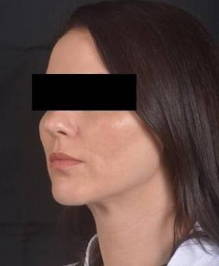 Neck Liposuction Before & After Gallery - Patient 217109 - Image 8