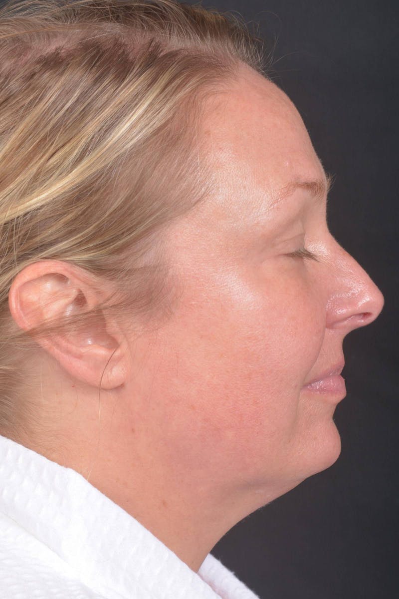 Facelift Before & After Gallery - Patient 212742 - Image 5