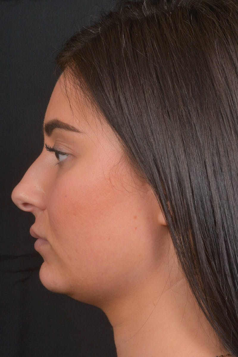 Neck Liposuction Before & After Gallery - Patient 393276 - Image 3