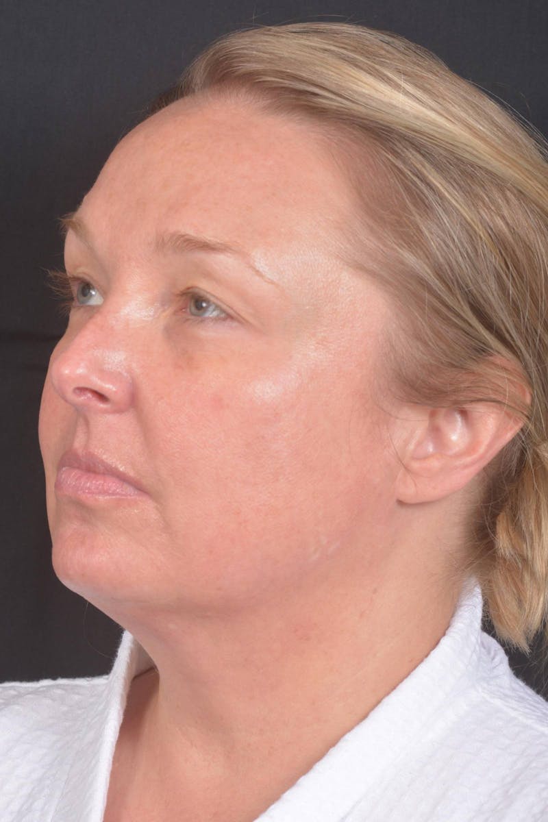 Facelift Before & After Gallery - Patient 212742 - Image 7