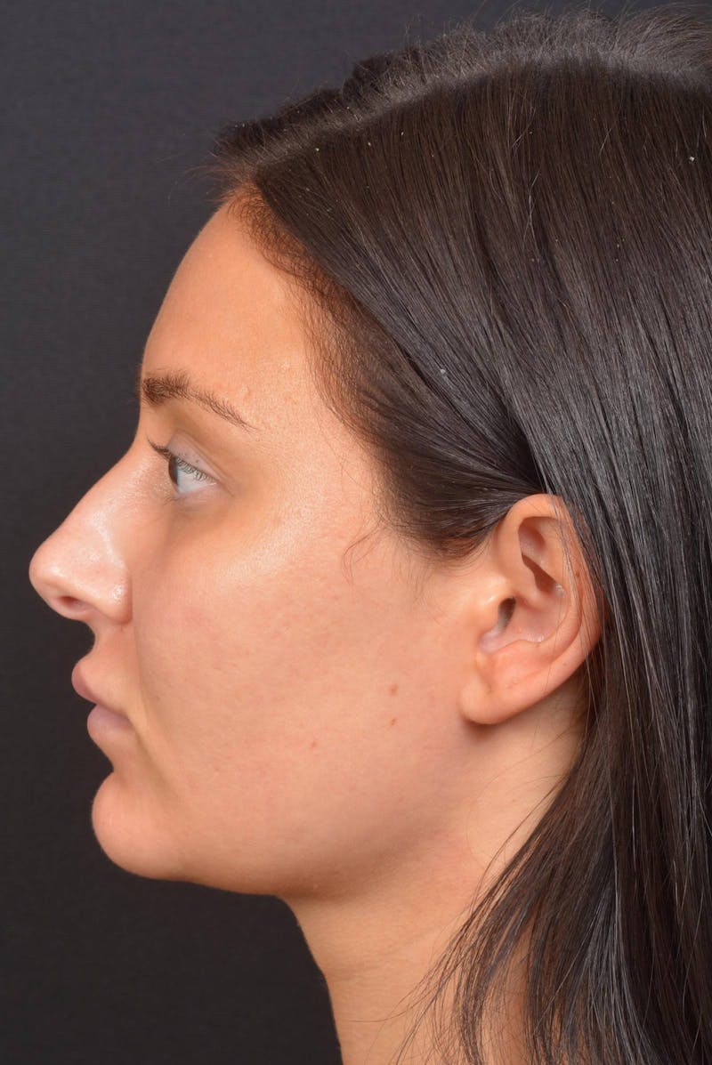 Neck Liposuction Before & After Gallery - Patient 393276 - Image 4