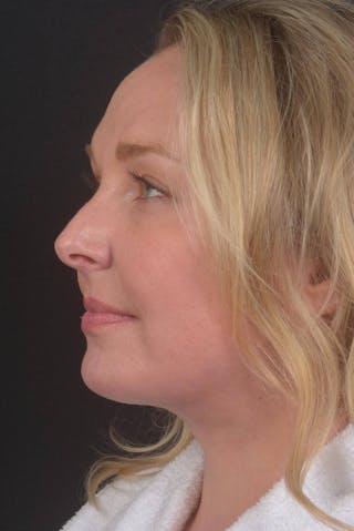 Facelift Before & After Gallery - Patient 212742 - Image 8