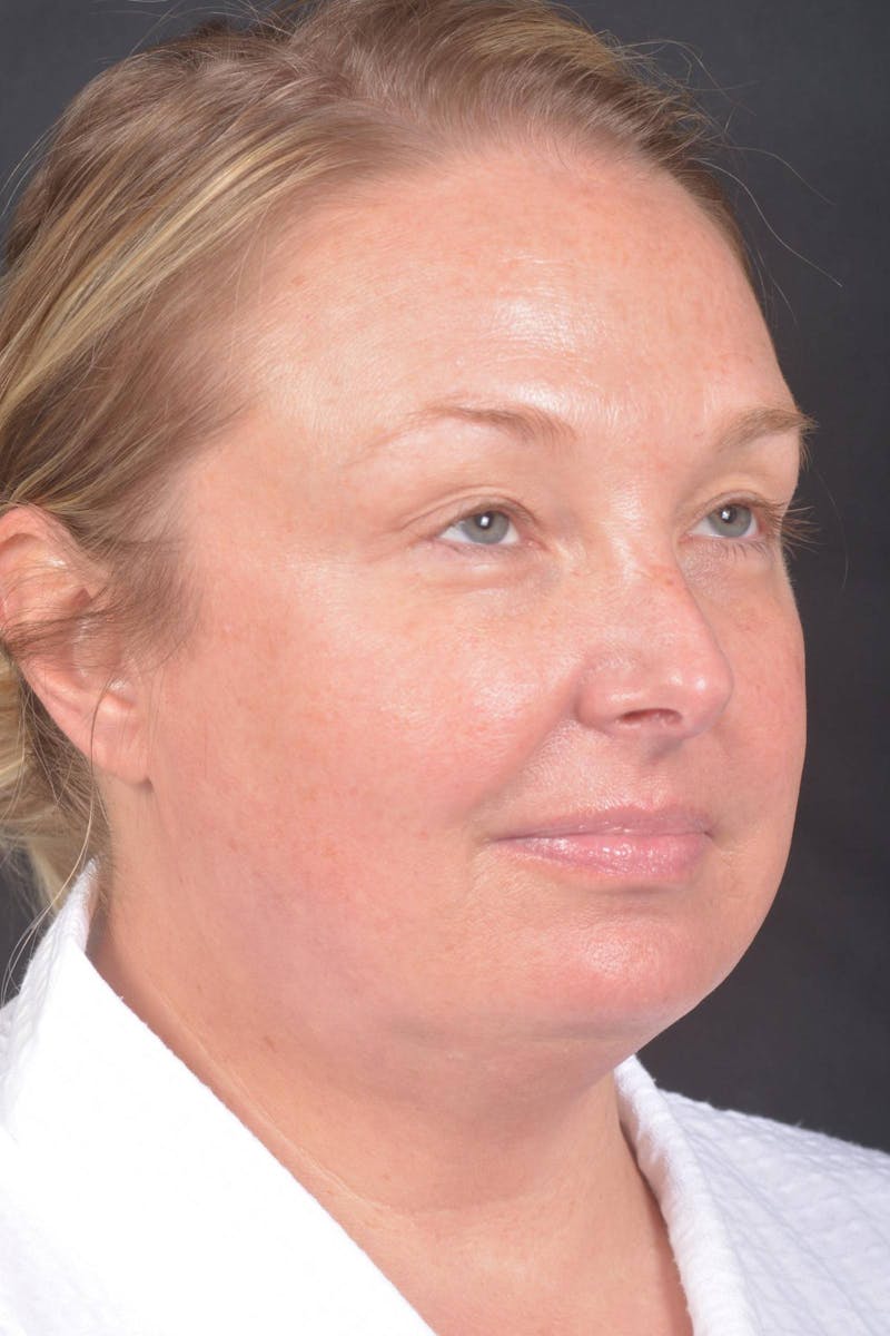 Facelift Before & After Gallery - Patient 212742 - Image 9