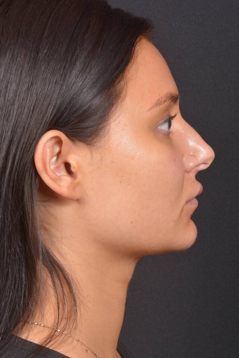 Neck Liposuction Before & After Gallery - Patient 393276 - Image 6