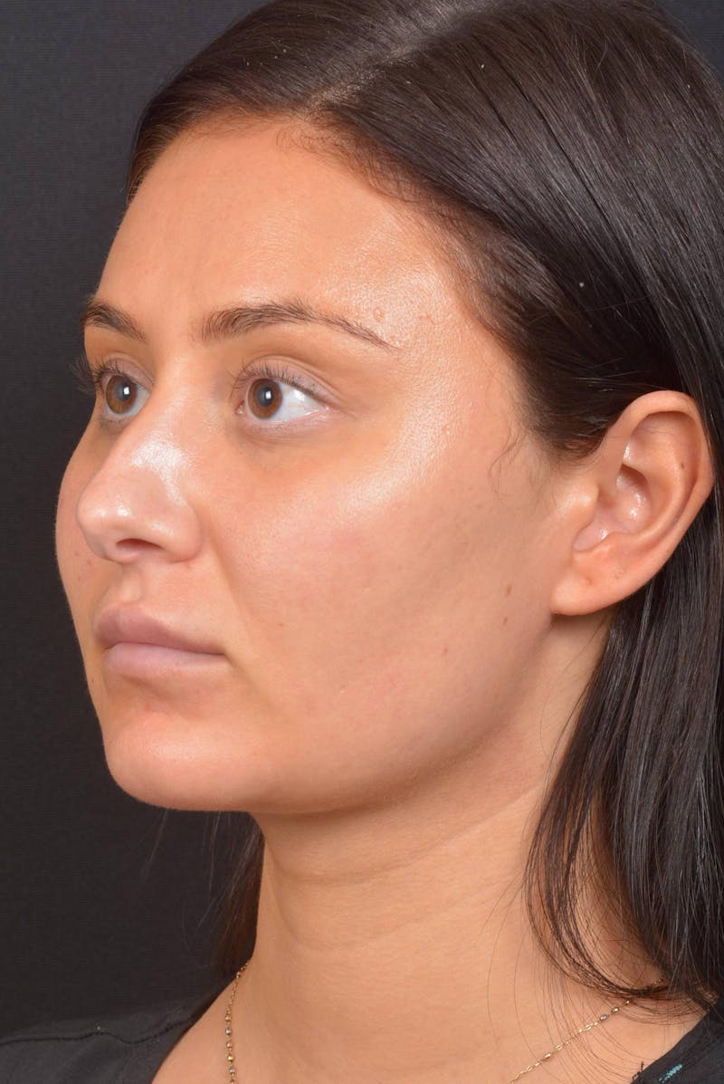 Neck Liposuction Before & After Gallery - Patient 393276 - Image 8