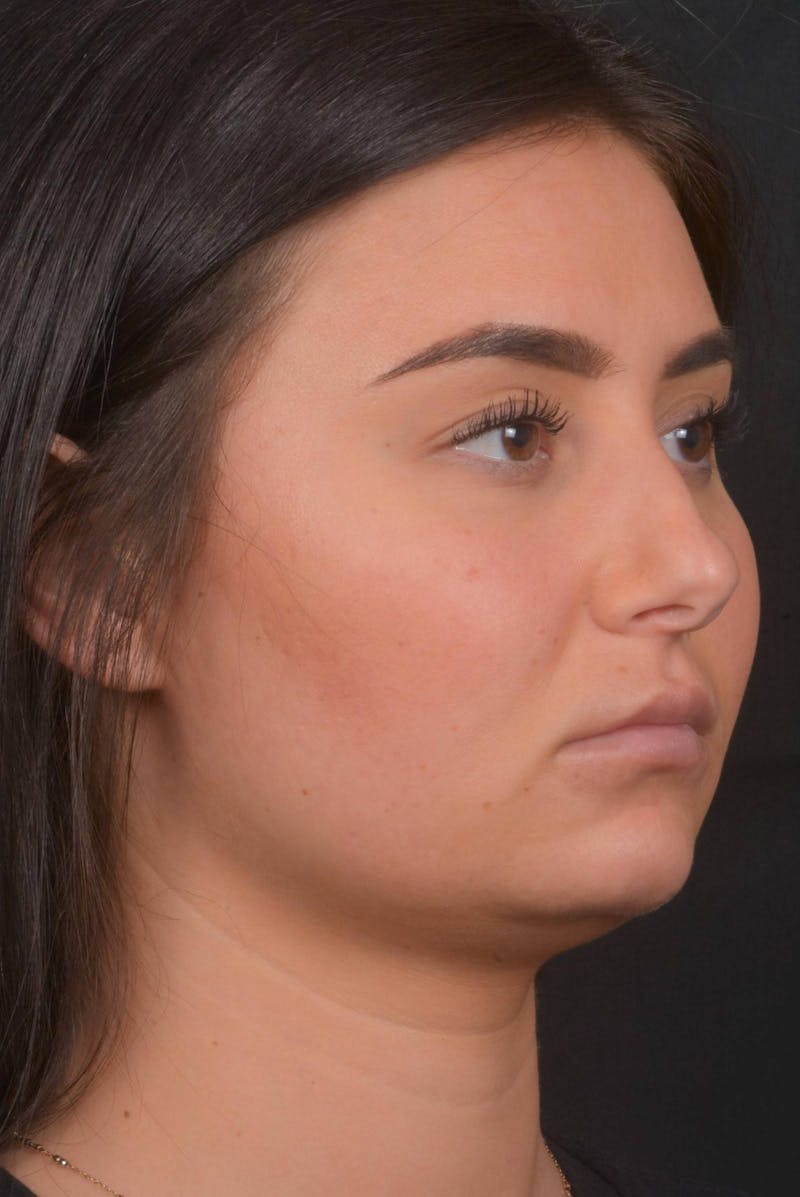 Neck Liposuction Before & After Gallery - Patient 393276 - Image 9