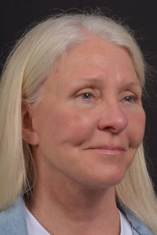 Facelift Before & After Gallery - Patient 217040 - Image 10