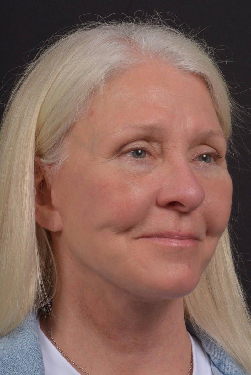 Facelift Before & After Gallery - Patient 217040 - Image 10
