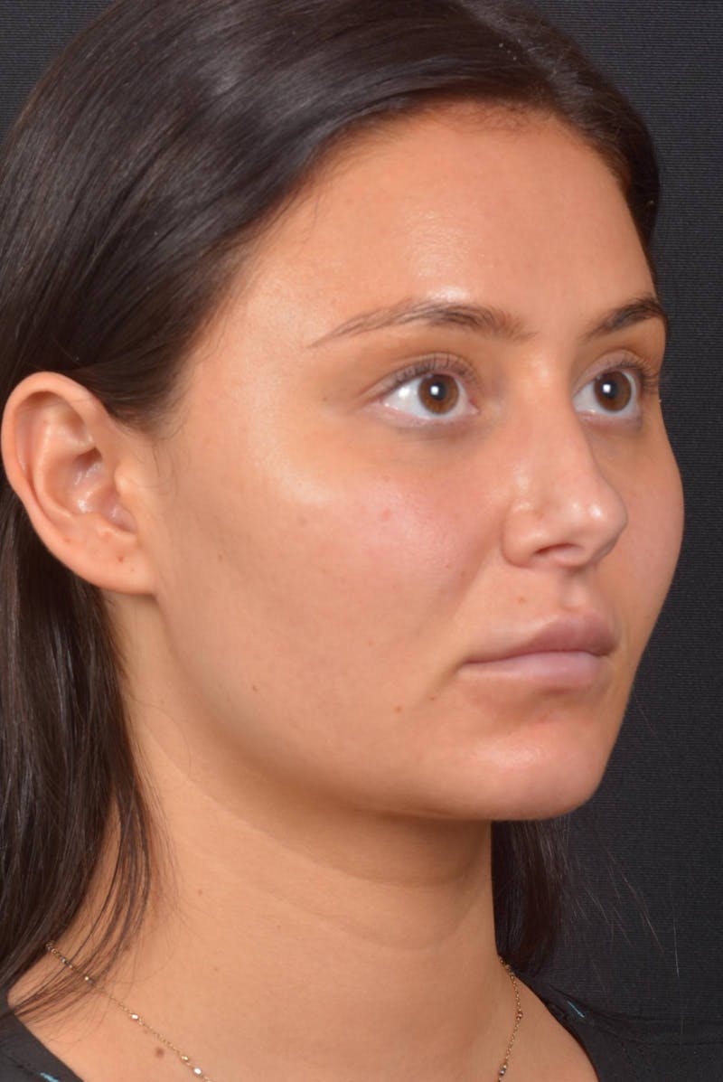 Neck Liposuction Before & After Gallery - Patient 393276 - Image 10