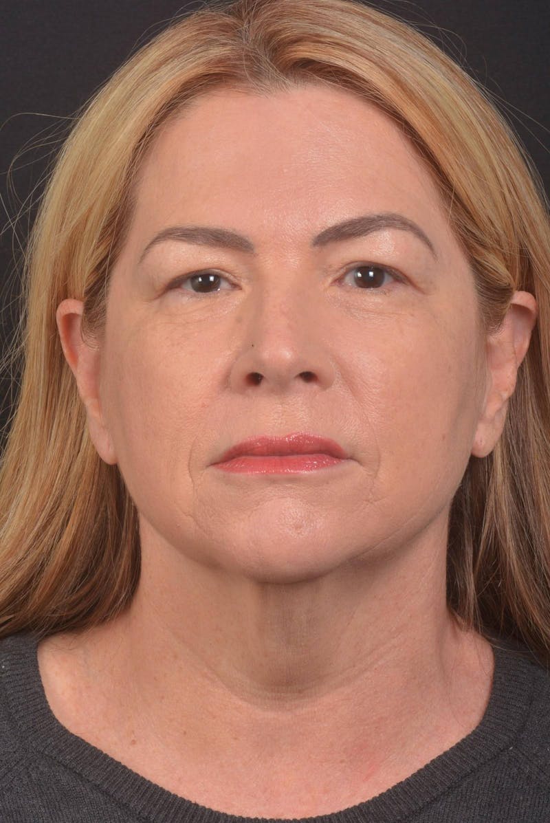 Facelift Before & After Gallery - Patient 827365 - Image 3