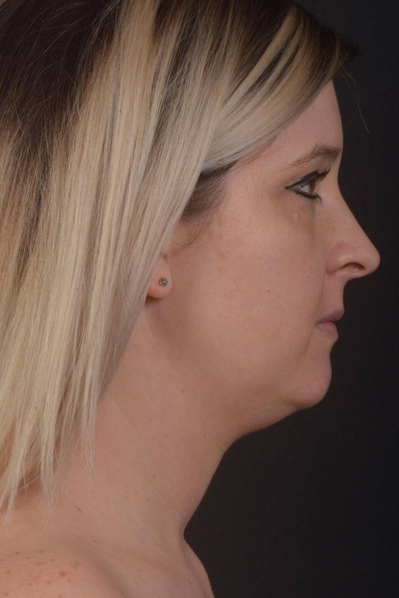 Neck Liposuction Before & After Gallery - Patient 427045 - Image 5