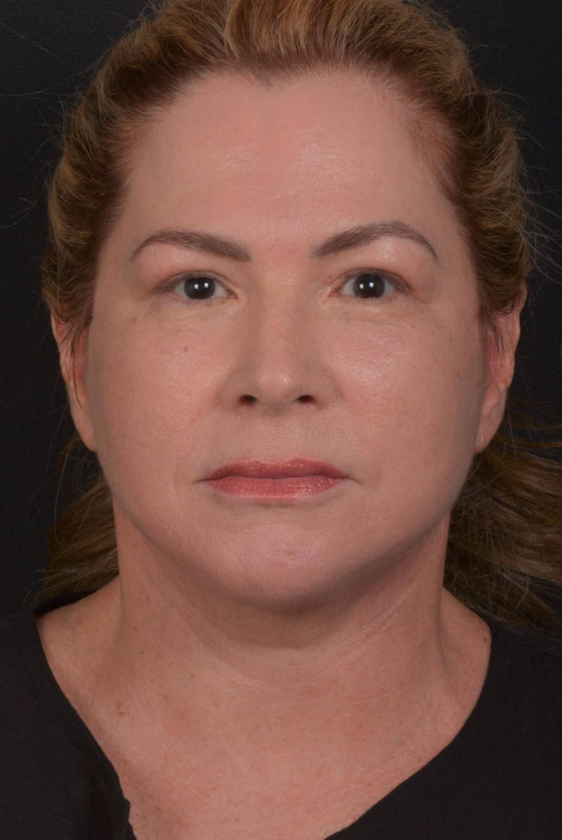 Facelift Before & After Gallery - Patient 827365 - Image 4