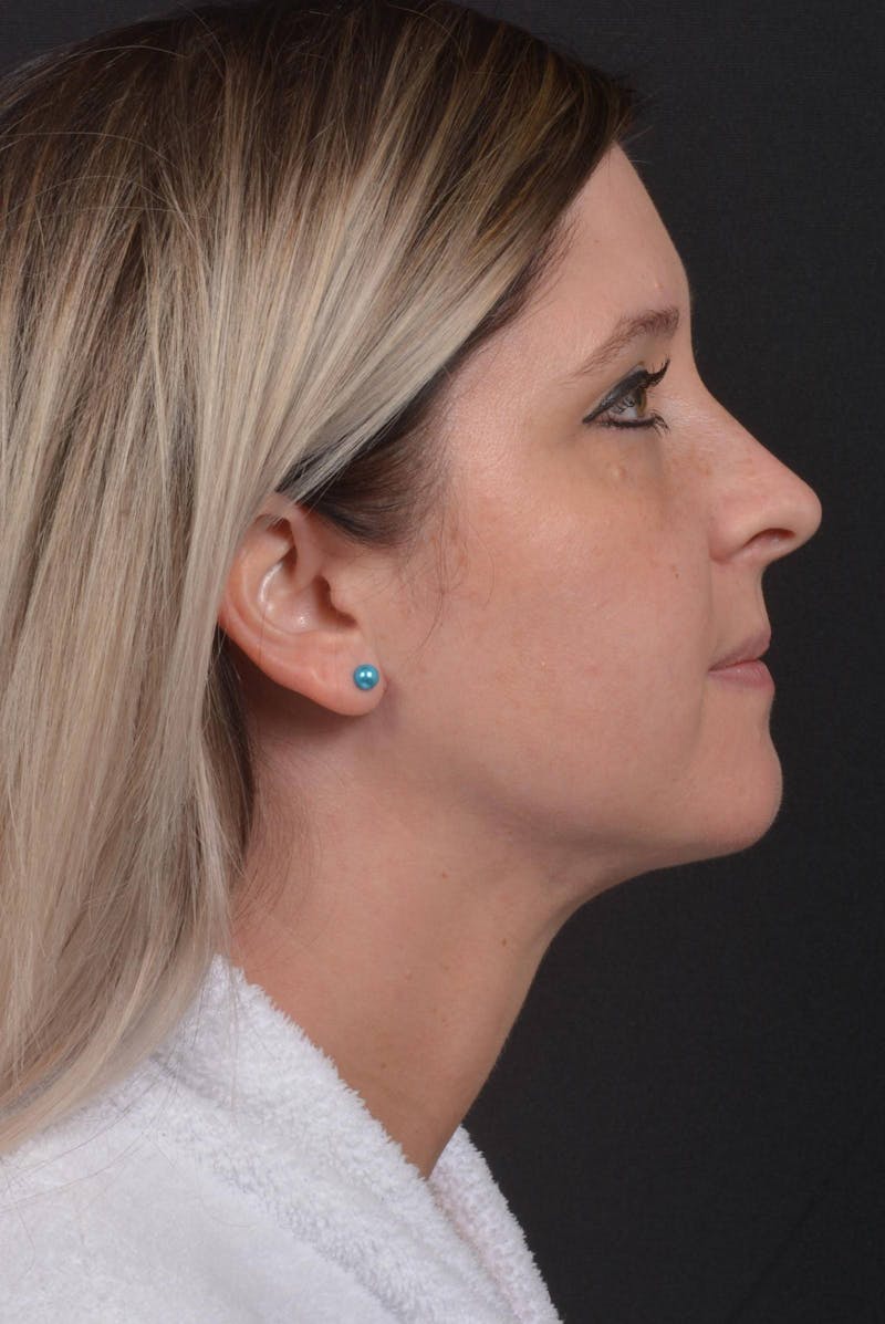 Neck Liposuction Before & After Gallery - Patient 427045 - Image 6