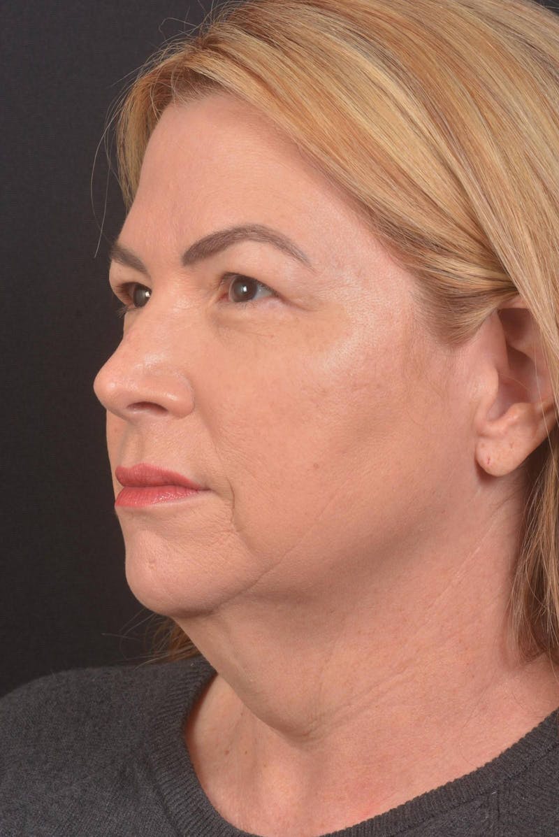 Facelift Before & After Gallery - Patient 827365 - Image 5