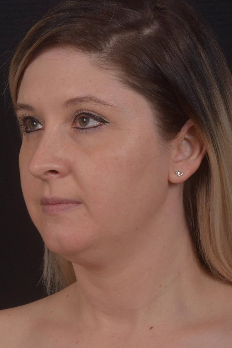 Neck Liposuction Before & After Gallery - Patient 427045 - Image 7