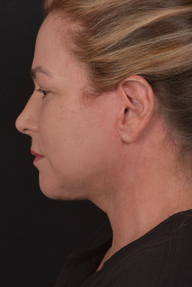 Facelift Before & After Gallery - Patient 827365 - Image 8