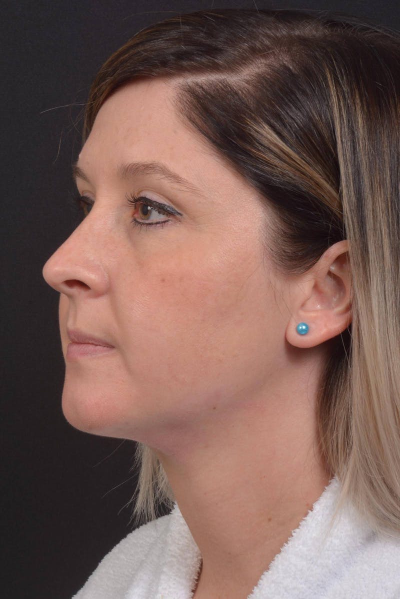 Neck Liposuction Before & After Gallery - Patient 427045 - Image 8