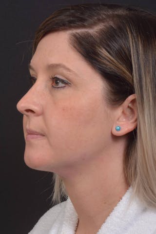 Neck Liposuction Before & After Gallery - Patient 427045 - Image 8