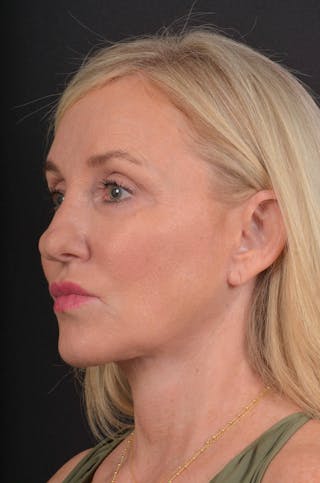 Facelift Before & After Gallery - Patient 276162 - Image 6