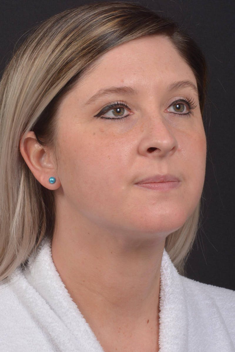 Neck Liposuction Before & After Gallery - Patient 427045 - Image 10