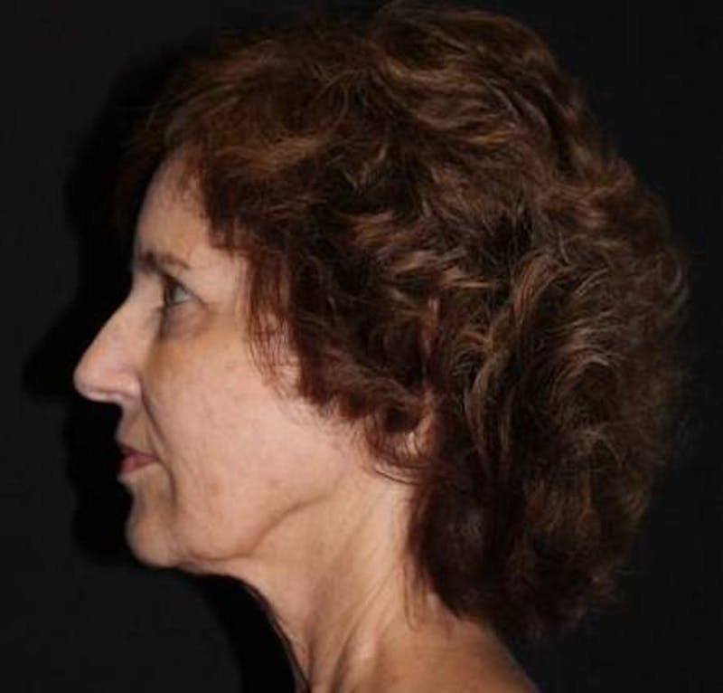 Facelift Before & After Gallery - Patient 191773 - Image 5