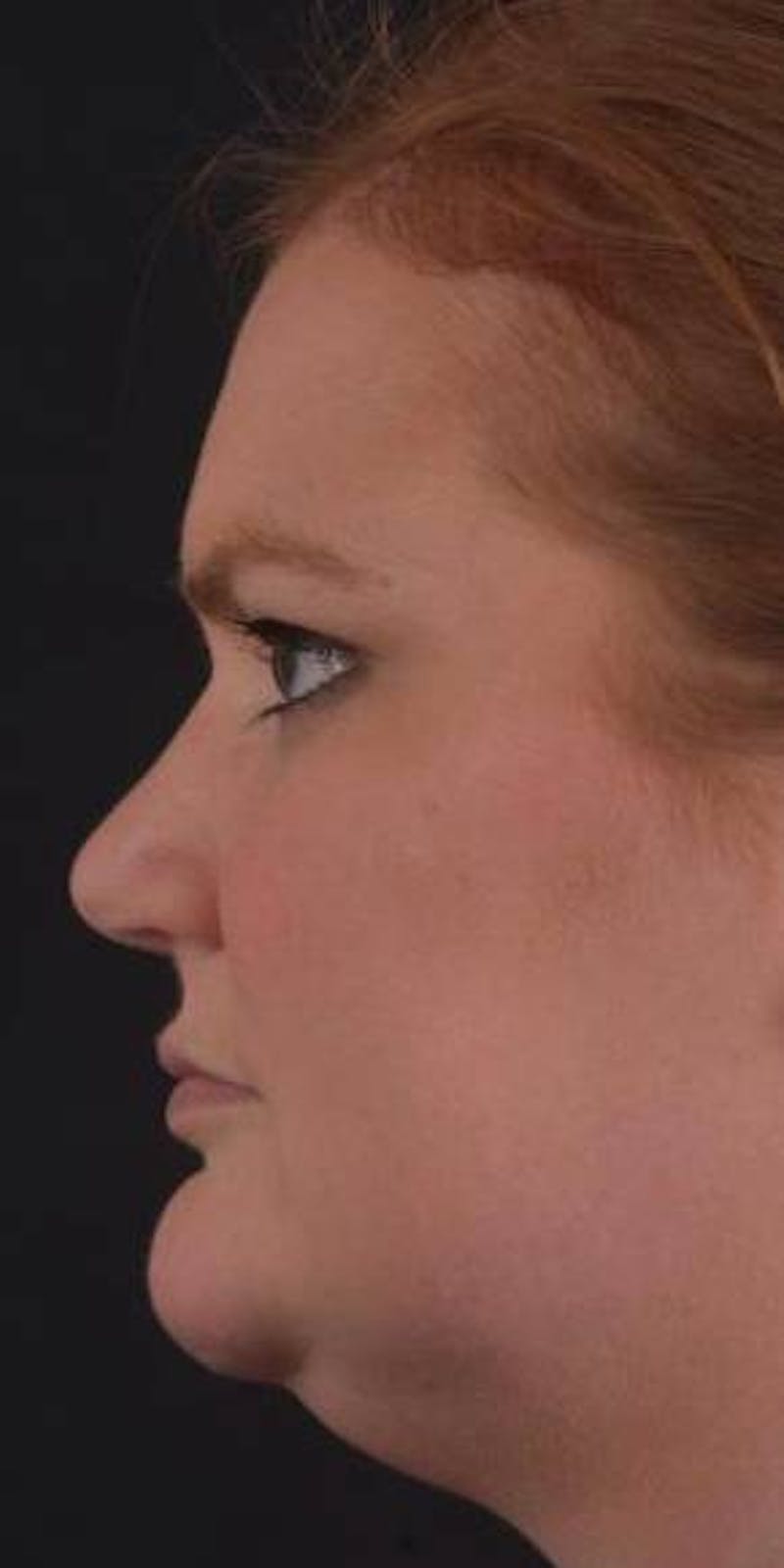 Neck Liposuction Before & After Gallery - Patient 366338 - Image 3