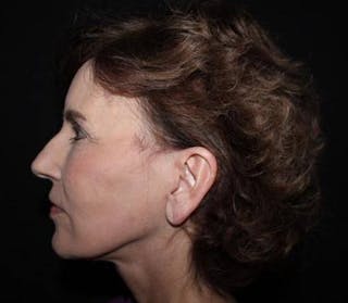 Facelift Before & After Gallery - Patient 191773 - Image 6