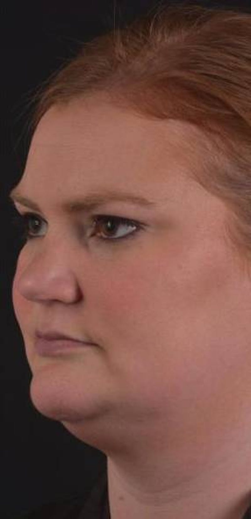 Neck Liposuction Before & After Gallery - Patient 366338 - Image 5