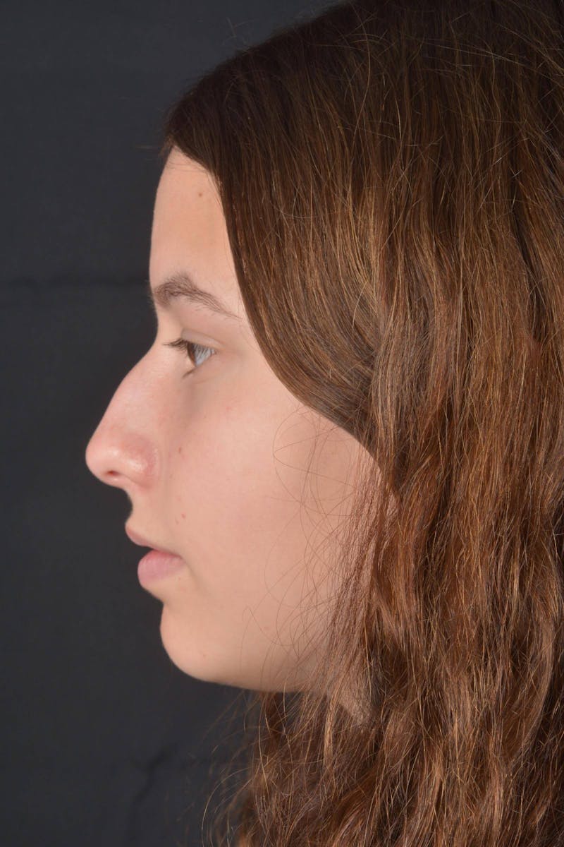 Rhinoplasty Before & After Gallery - Patient 327246 - Image 3