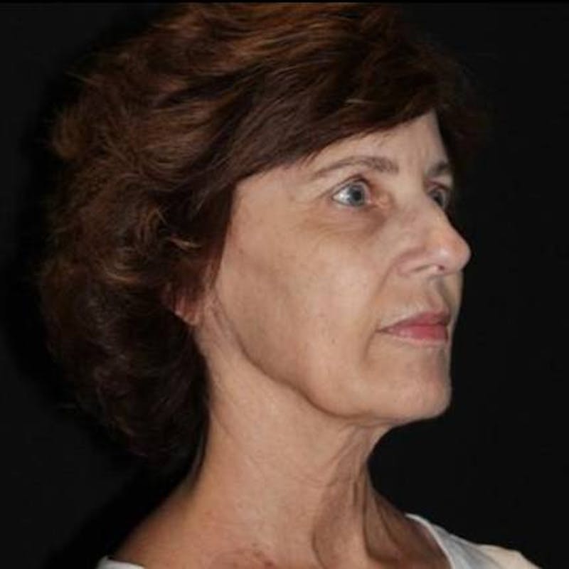 Facelift Before & After Gallery - Patient 191773 - Image 7