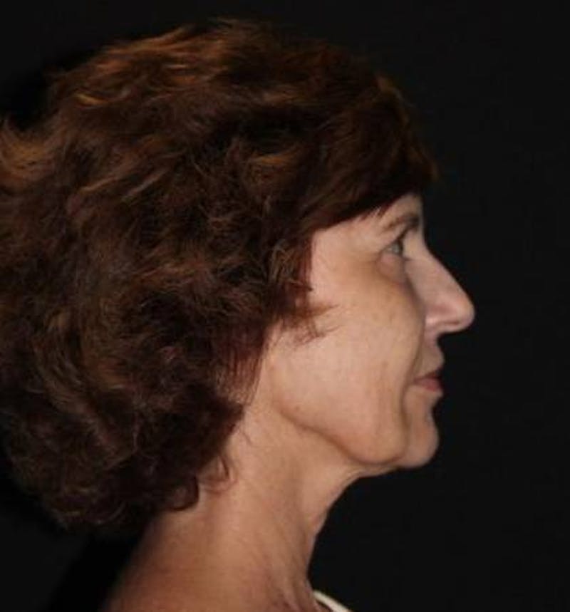 Facelift Before & After Gallery - Patient 191773 - Image 9