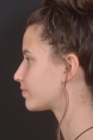 Rhinoplasty Before & After Gallery - Patient 327246 - Image 4