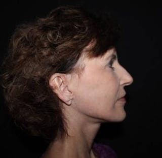 Facelift Before & After Gallery - Patient 191773 - Image 10
