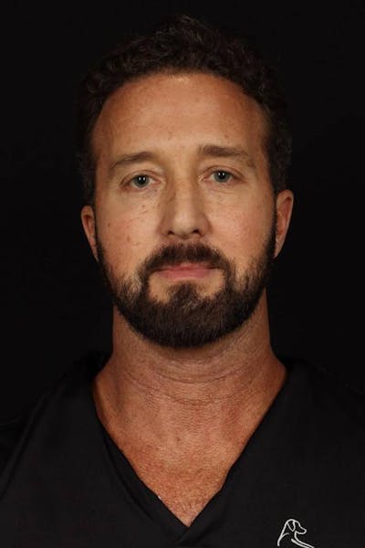 Blepharoplasty Before & After Gallery - Patient 292990 - Image 1