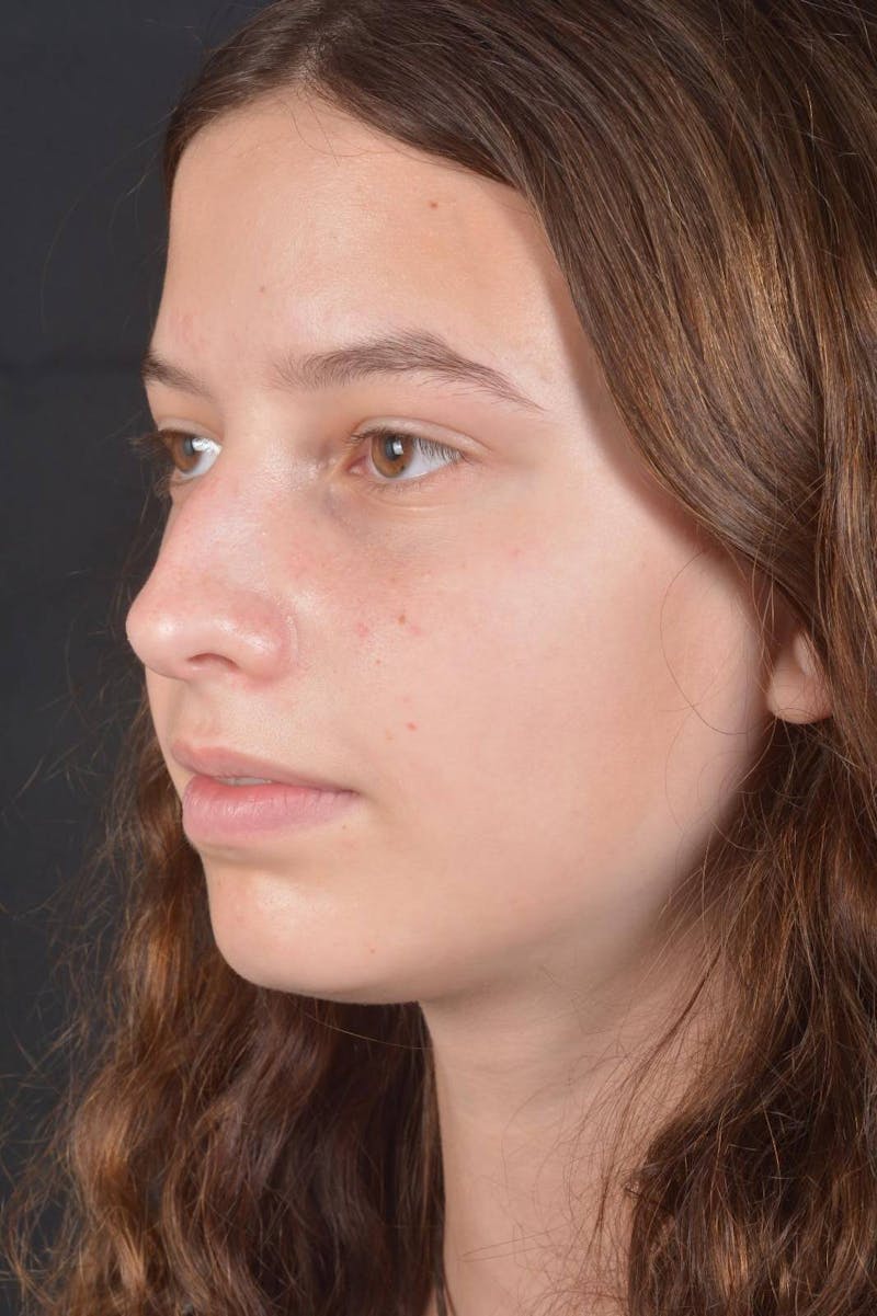 Rhinoplasty Before & After Gallery - Patient 327246 - Image 7