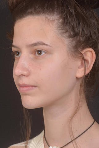 Rhinoplasty Before & After Gallery - Patient 327246 - Image 8