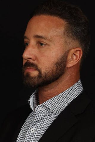 Blepharoplasty Before & After Gallery - Patient 292990 - Image 4