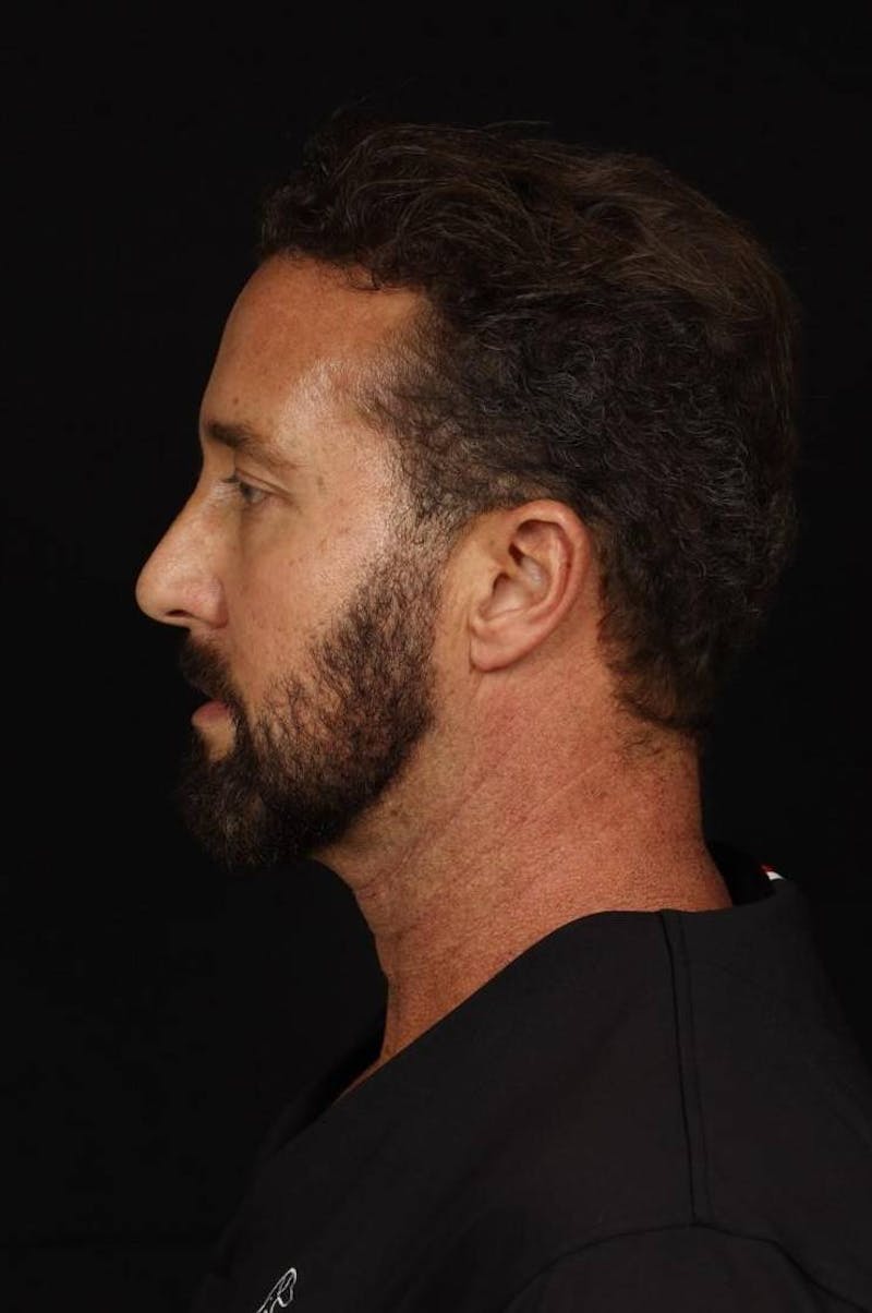 Facelift Before & After Gallery - Patient 308040 - Image 5