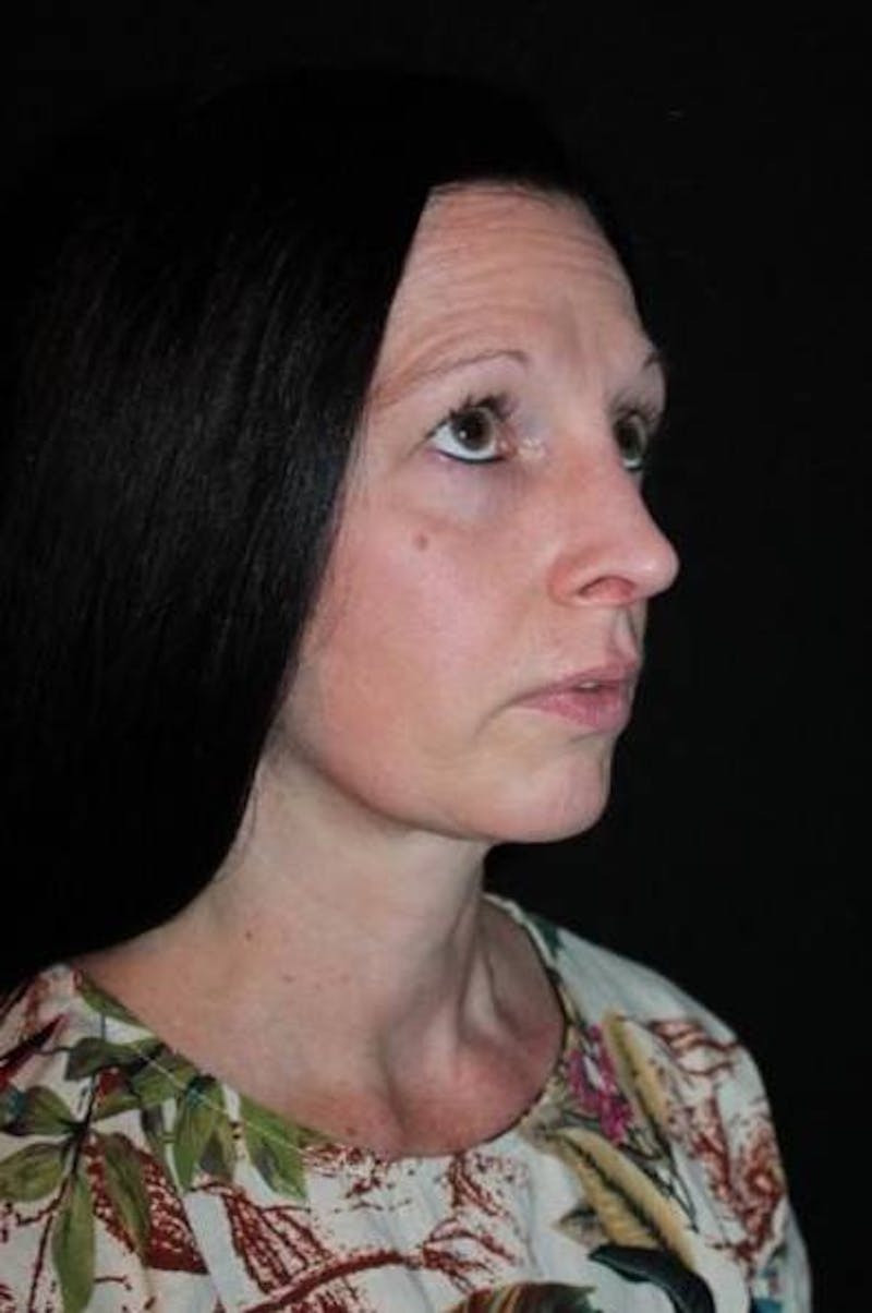 Rhinoplasty Before & After Gallery - Patient 408641 - Image 8