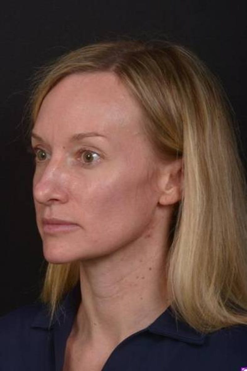 Rhinoplasty Before & After Gallery - Patient 383581 - Image 3