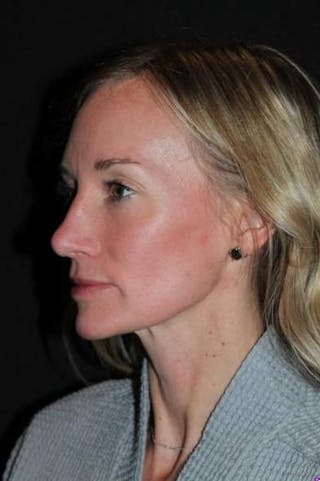 Rhinoplasty Before & After Gallery - Patient 383581 - Image 4