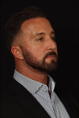 Facelift Before & After Gallery - Patient 308040 - Image 8