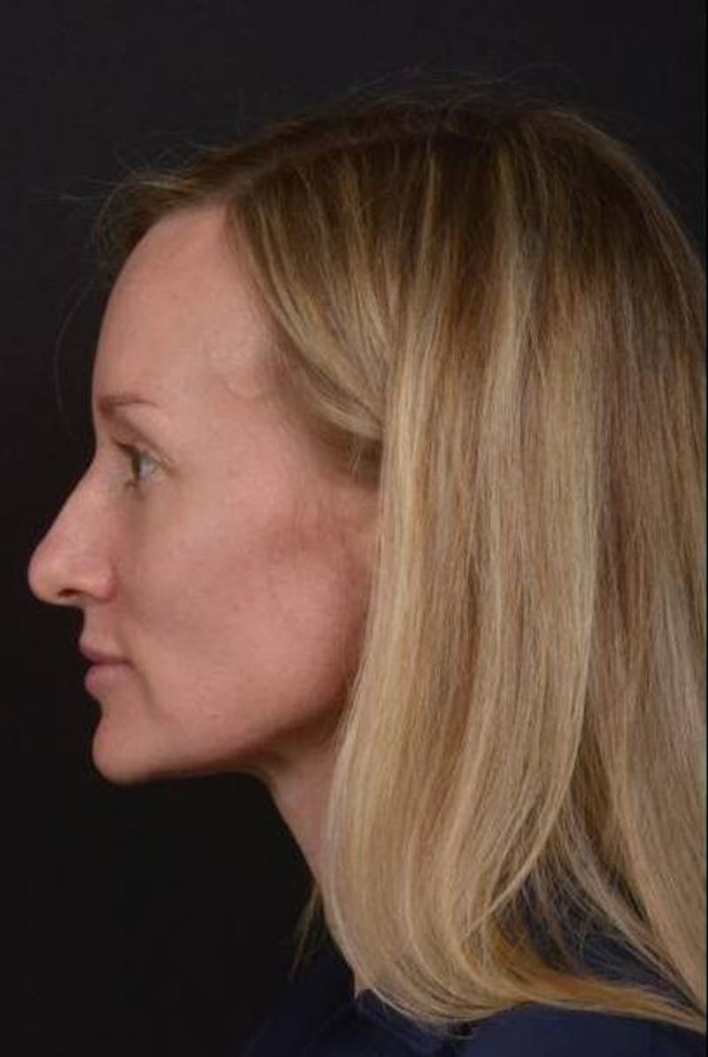 Rhinoplasty Before & After Gallery - Patient 383581 - Image 5