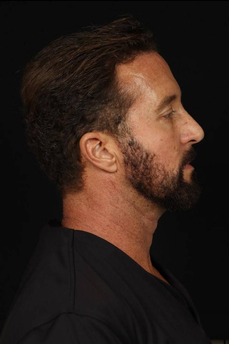 Facelift Before & After Gallery - Patient 308040 - Image 9