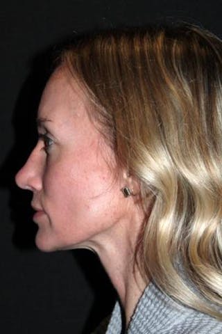 Rhinoplasty Before & After Gallery - Patient 383581 - Image 6