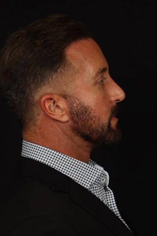 Facelift Before & After Gallery - Patient 308040 - Image 10